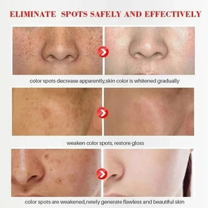 Powerful Spot-removing Whiten Cream Pigmentation Melasma Dark Spot Skin Care 20g