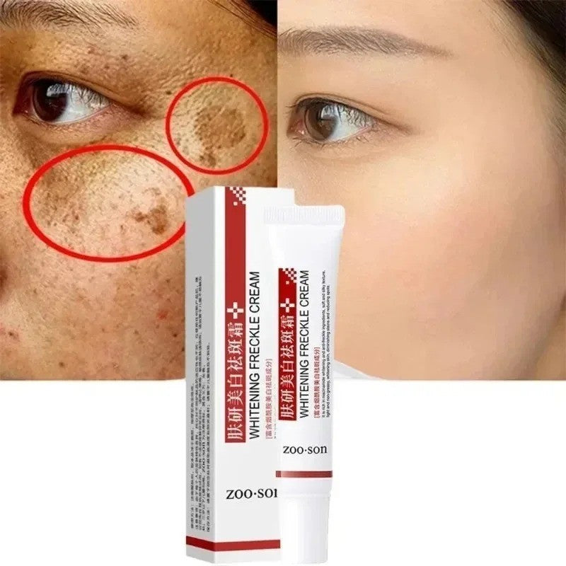Powerful Spot-removing Whiten Cream Pigmentation Melasma Dark Spot Skin Care 20g
