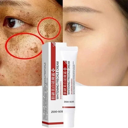 Powerful Spot-removing Whiten Cream Pigmentation Melasma Dark Spot Skin Care 20g