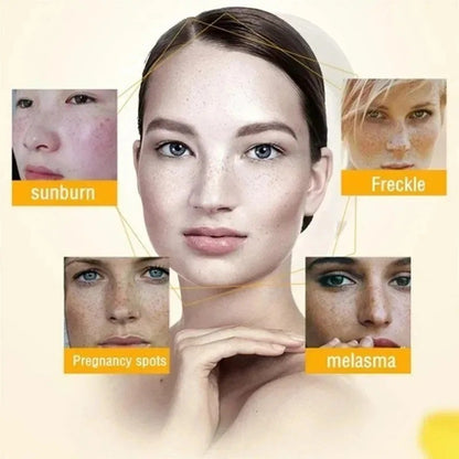 Powerful Spot-removing Whiten Cream Pigmentation Melasma Dark Spot Skin Care 20g